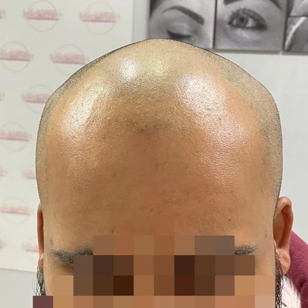 Scalp Micropigmentation Scalp Micropigmentation