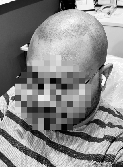 Scalp Micropigmentation Scalp Micropigmentation