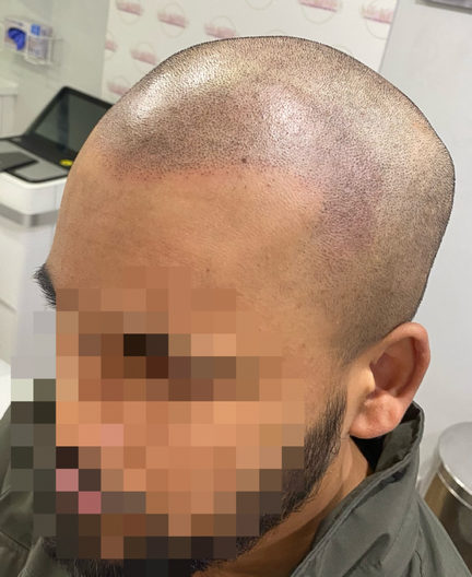 Scalp Micropigmentation Scalp Micropigmentation