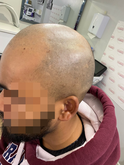 Scalp Micropigmentation Scalp Micropigmentation