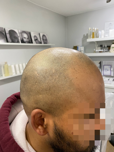 Scalp Micropigmentation Scalp Micropigmentation