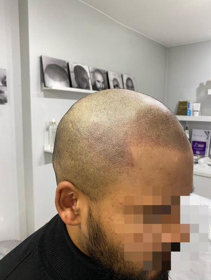 Scalp Micropigmentation Scalp Micropigmentation