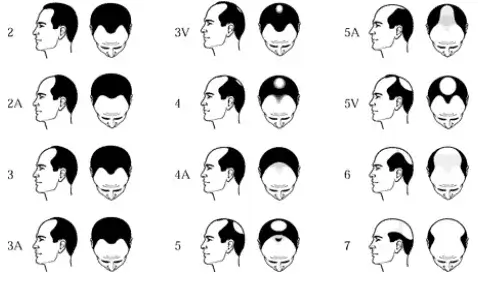 Norwood Scale